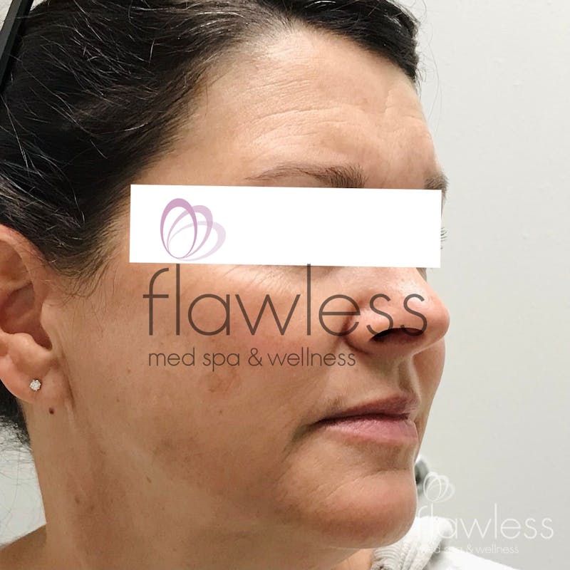 Pico Laser Skin Rejuvenation Before & After Gallery - Patient 58193415 - Image 1