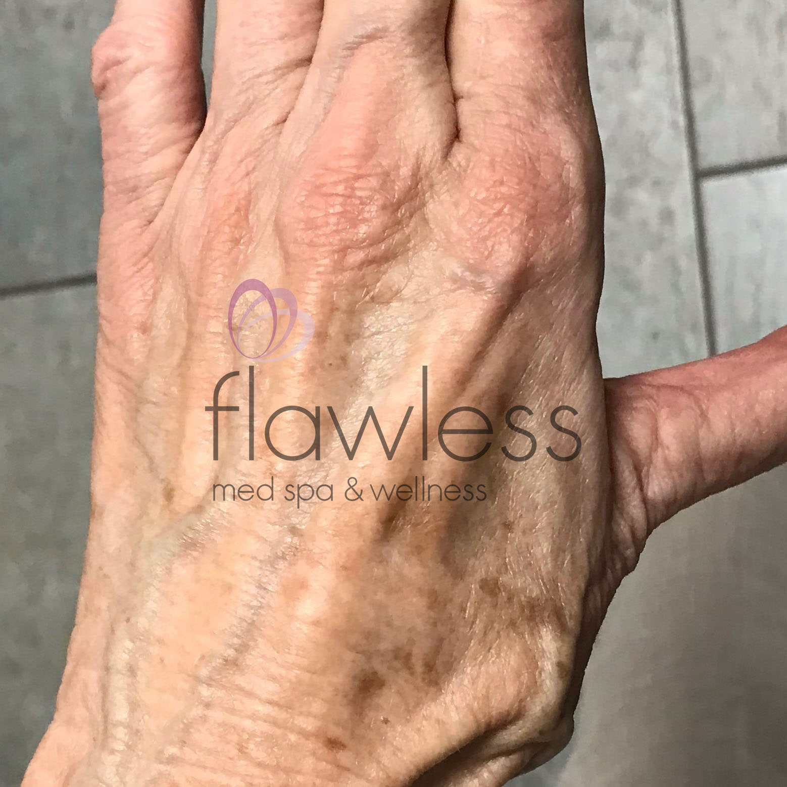 Age Spots - Body Before & After Gallery - Patient 58193417 - Image 1