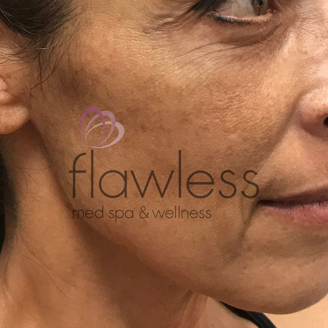 Pico Laser Skin Rejuvenation Before & After Gallery - Patient 58193418 - Image 2