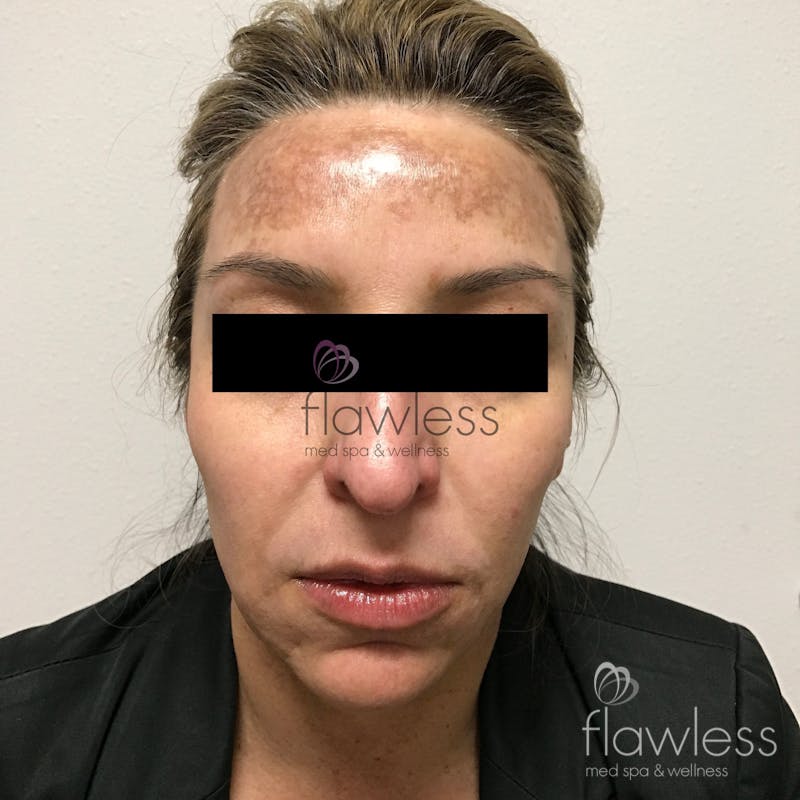 Pico Laser Skin Rejuvenation Before & After Gallery - Patient 58193420 - Image 1