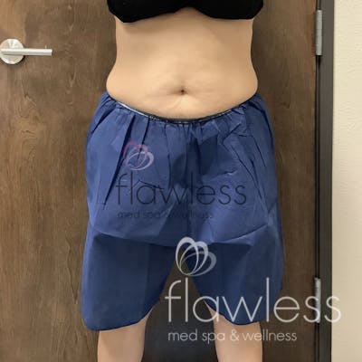 Coolsculpting Before & After Gallery - Patient 58193421 - Image 1