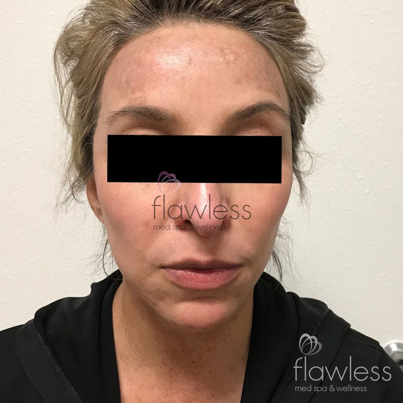 Pico Laser Skin Rejuvenation Before & After Gallery - Patient 58193420 - Image 2