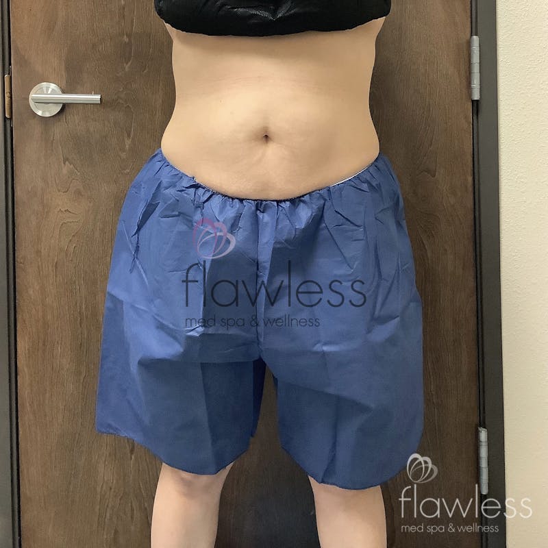 Coolsculpting Before & After Gallery - Patient 58193421 - Image 2