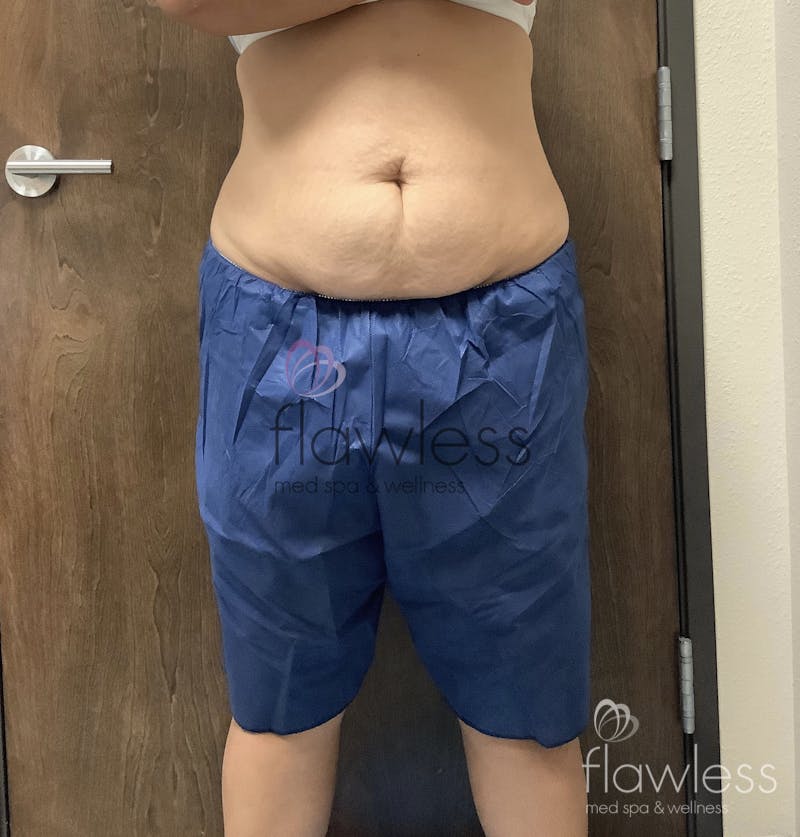 Coolsculpting Before & After Gallery - Patient 58193423 - Image 1