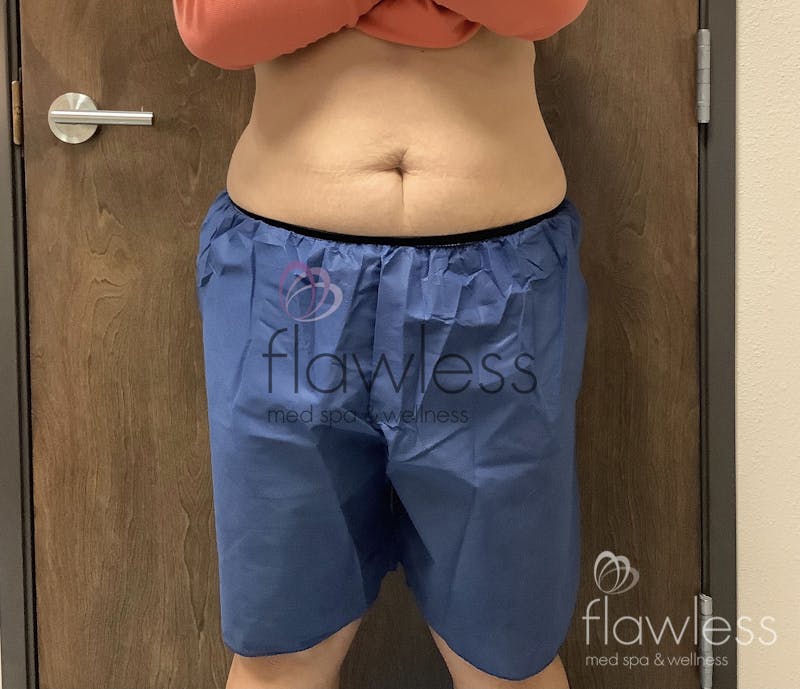 Coolsculpting Before & After Gallery - Patient 58193423 - Image 2