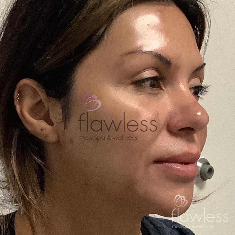 Pico Laser Skin Rejuvenation Before & After Gallery - Patient 58193424 - Image 2