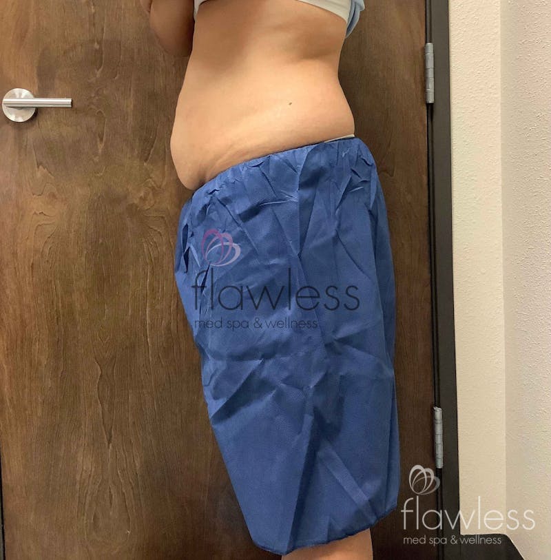 Coolsculpting Before & After Gallery - Patient 58193423 - Image 3