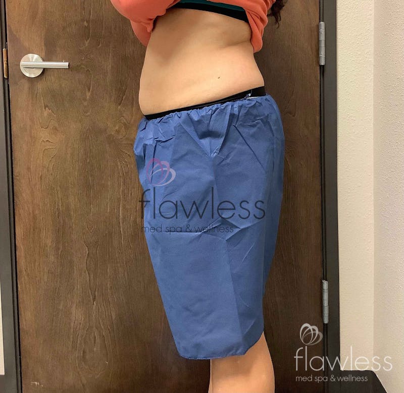 Coolsculpting Before & After Gallery - Patient 58193423 - Image 4