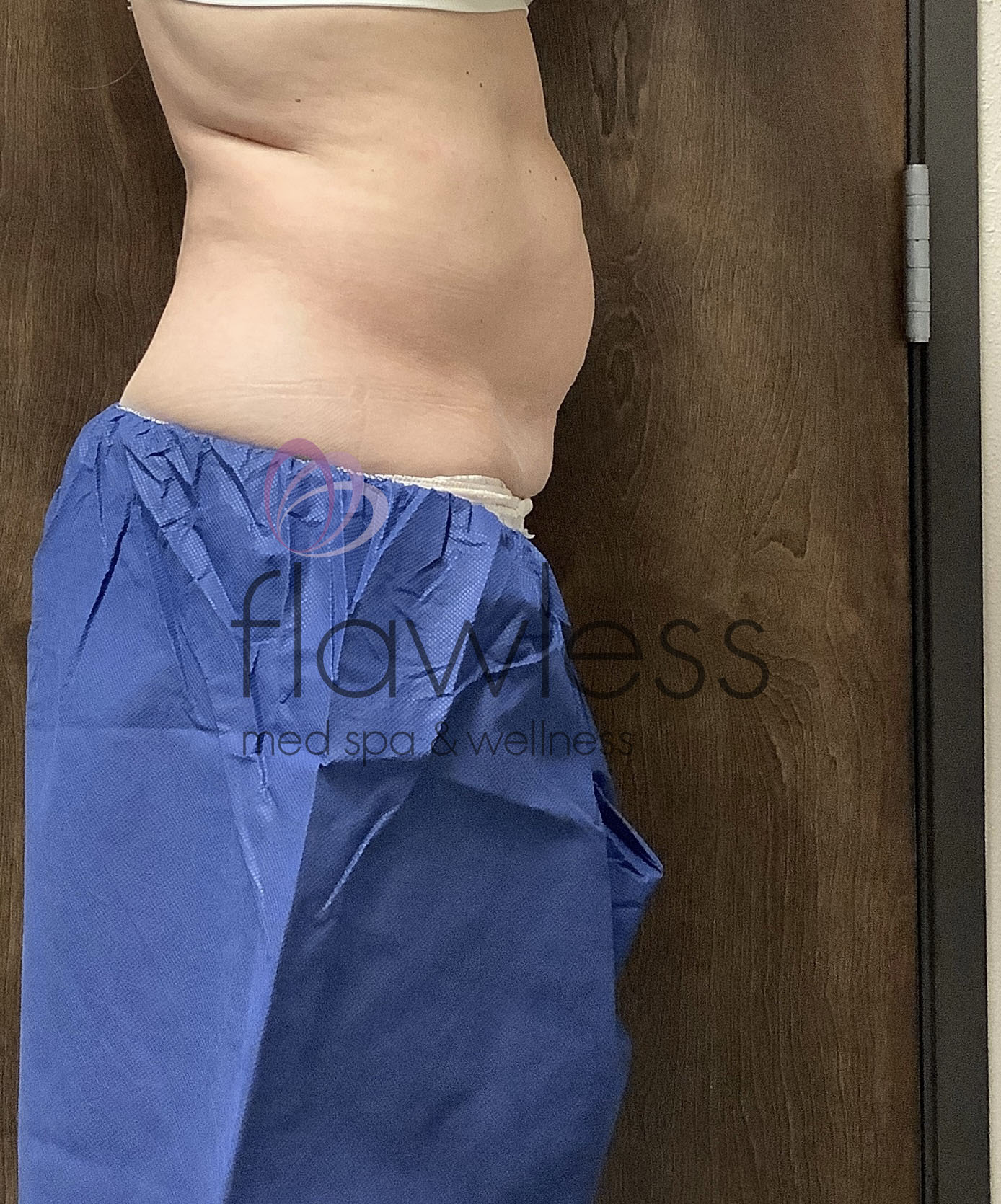 Coolsculpting Before & After Gallery - Patient 58193427 - Image 1