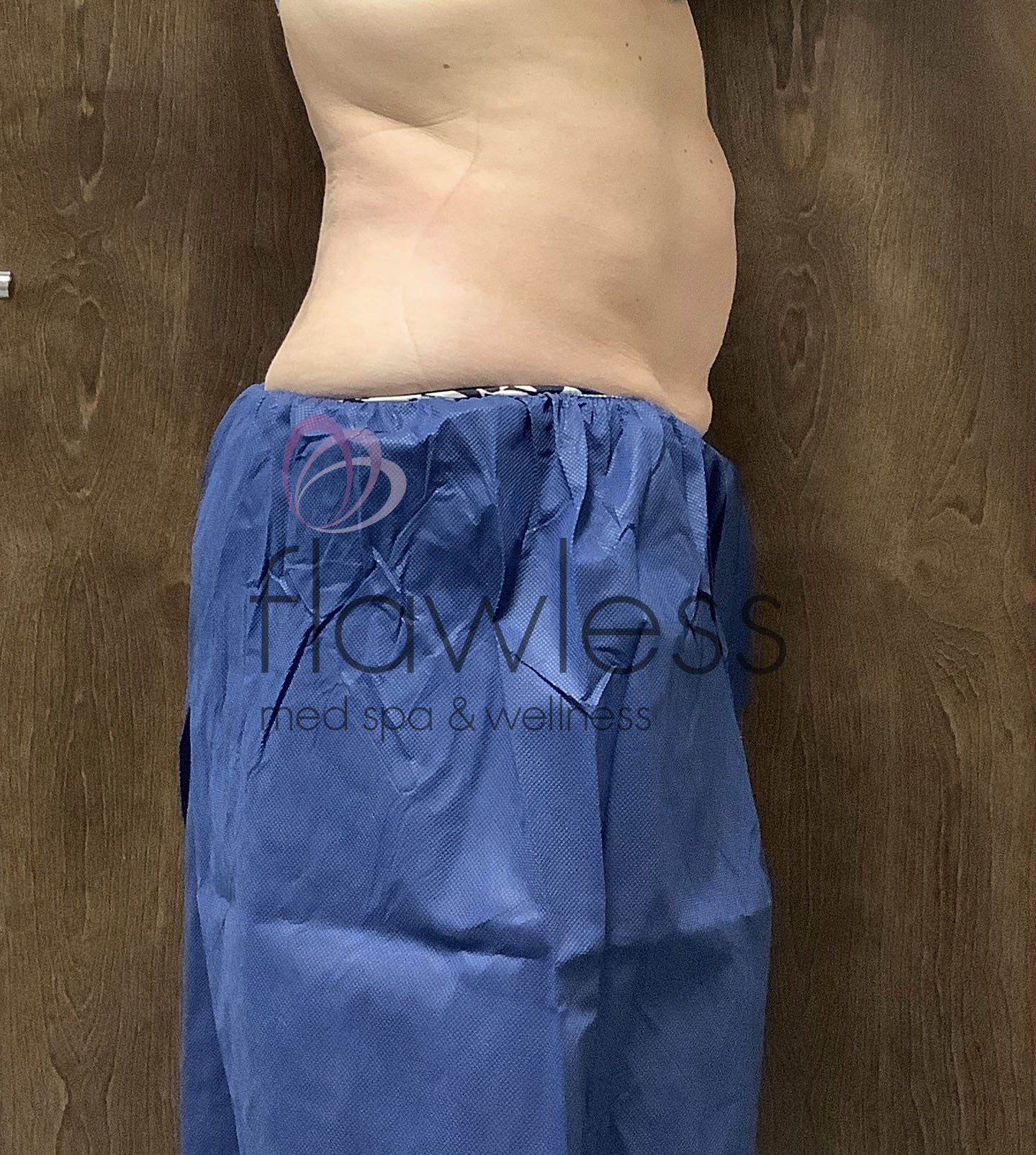 Coolsculpting Before & After Gallery - Patient 58193427 - Image 2