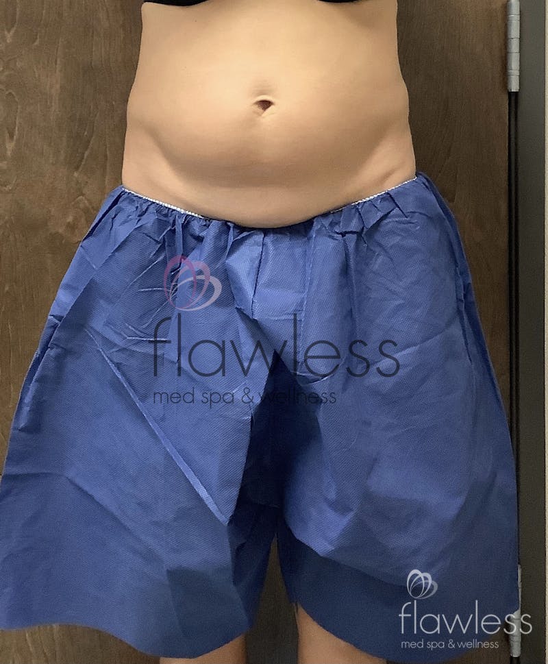Coolsculpting Before & After Gallery - Patient 58193427 - Image 3