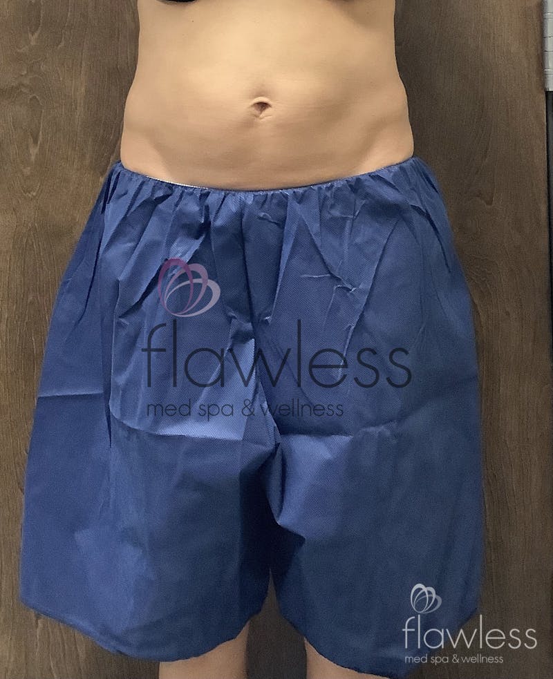 Coolsculpting Before & After Gallery - Patient 58193427 - Image 4