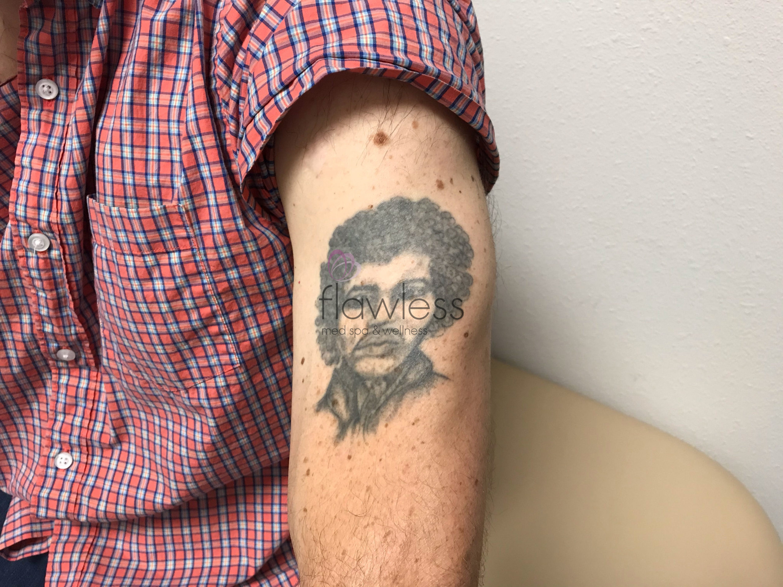 Laser Tattoo Removal Before & After Gallery - Patient 58193495 - Image 1