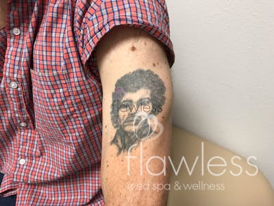 Laser Tattoo Removal Before & After Gallery - Patient 58193495 - Image 1