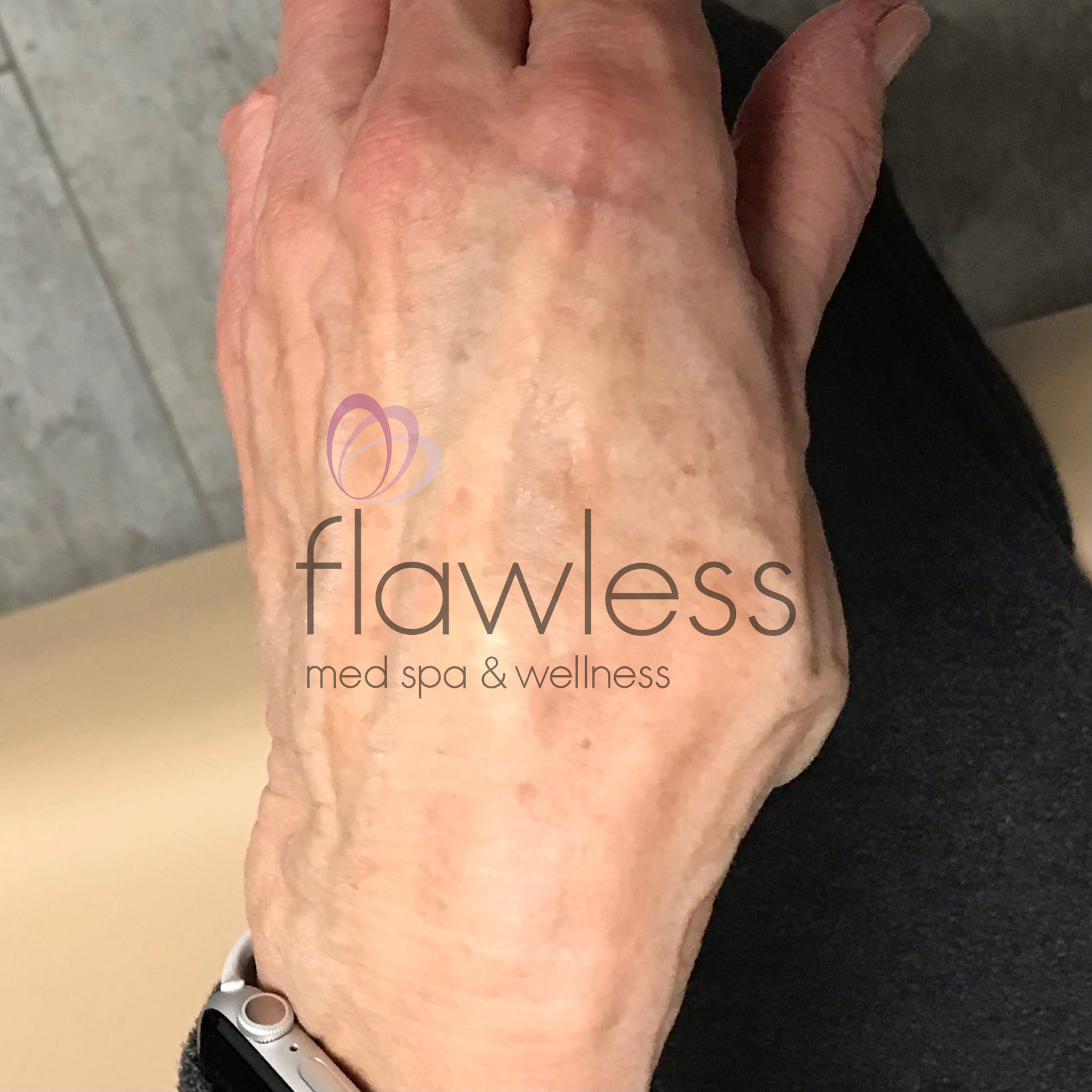 Pico Laser Skin Rejuvenation - Body Before & After Gallery - Patient 58193494 - Image 2