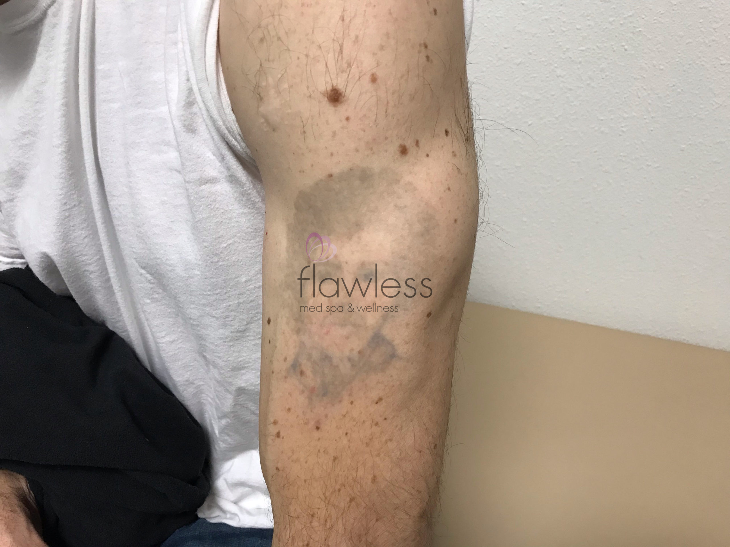 Laser Tattoo Removal Before & After Gallery - Patient 58193495 - Image 2