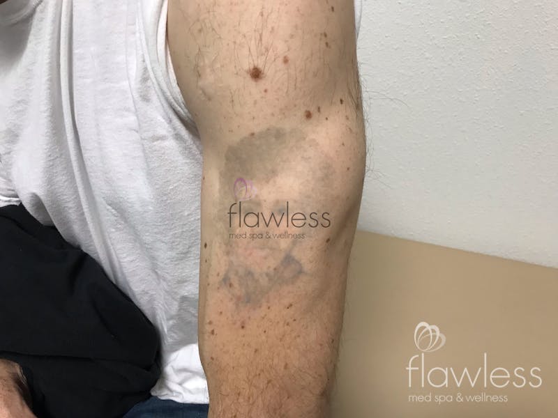 Laser Tattoo Removal Before & After Gallery - Patient 58193495 - Image 2