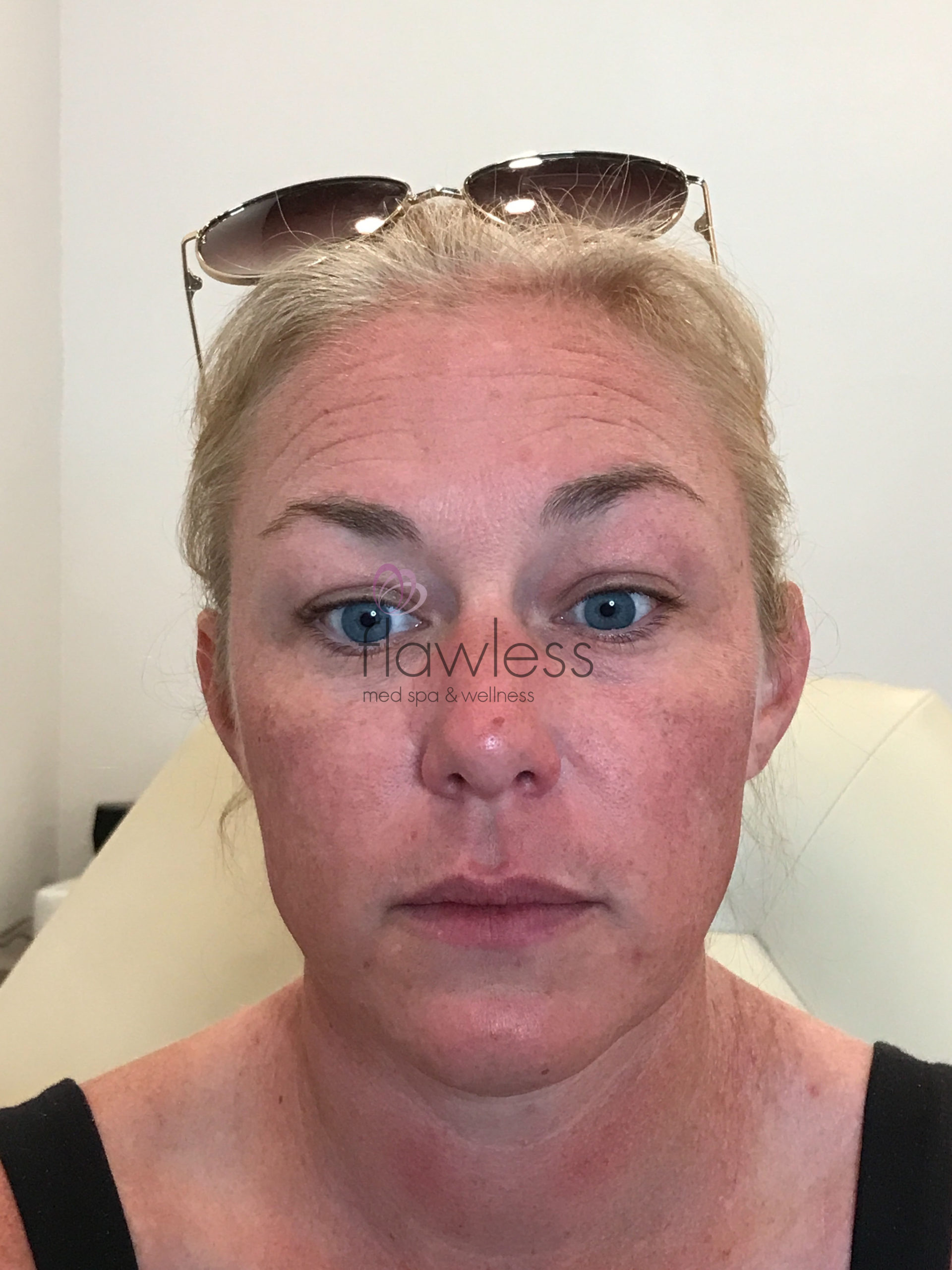 Pico Laser Skin Rejuvenation - Body Before & After Gallery - Patient 58193496 - Image 3