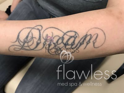 Laser Tattoo Removal Before & After Gallery - Patient 58193500 - Image 1