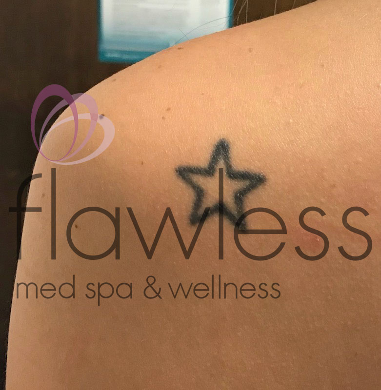 Laser Tattoo Removal Before & After Gallery - Patient 58193502 - Image 1