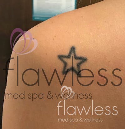 Laser Tattoo Removal Before & After Gallery - Patient 58193502 - Image 1