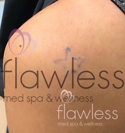 Laser Tattoo Removal Before & After Gallery - Patient 58193502 - Image 2