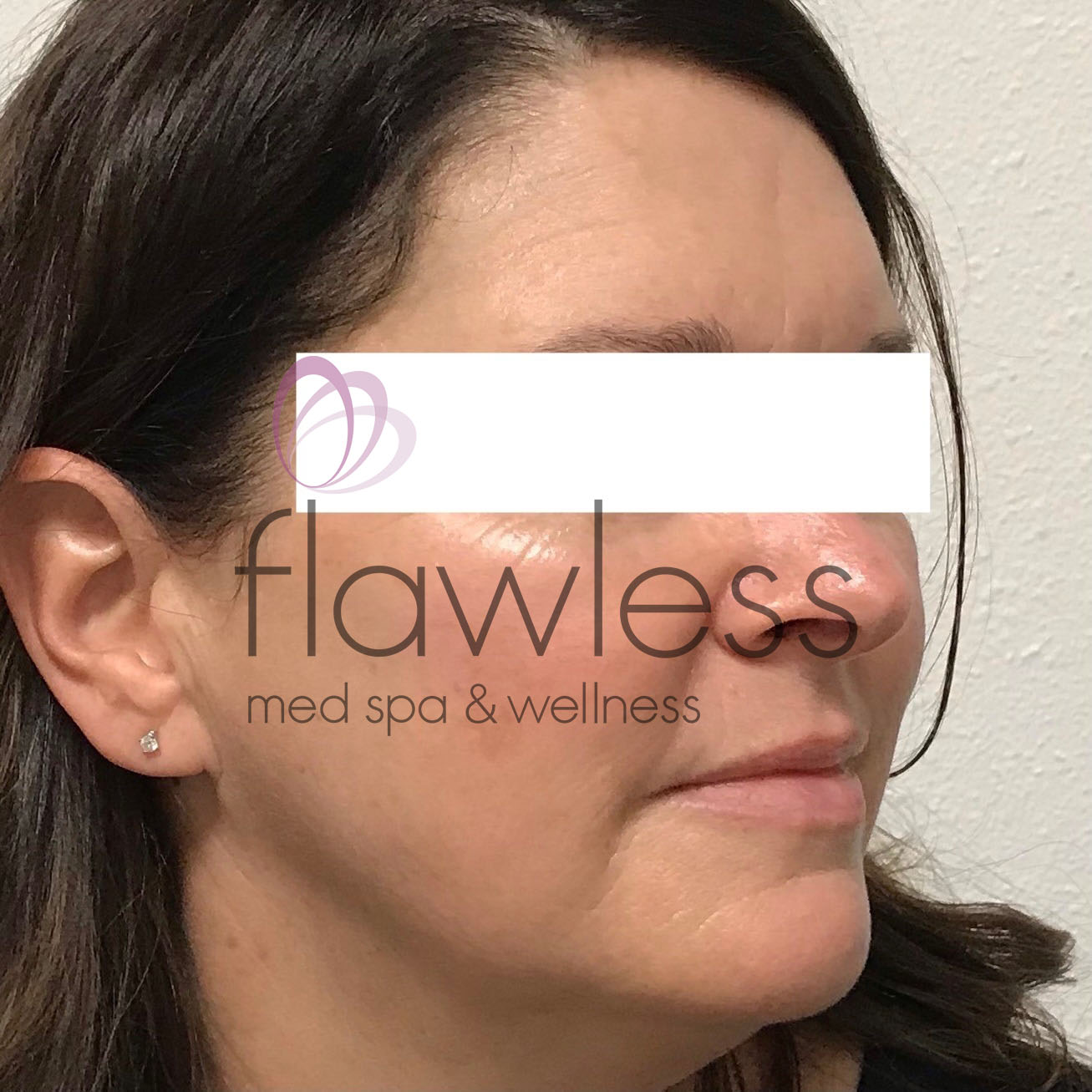 Pico Laser Skin Rejuvenation - Body Before & After Gallery - Patient 58193515 - Image 2