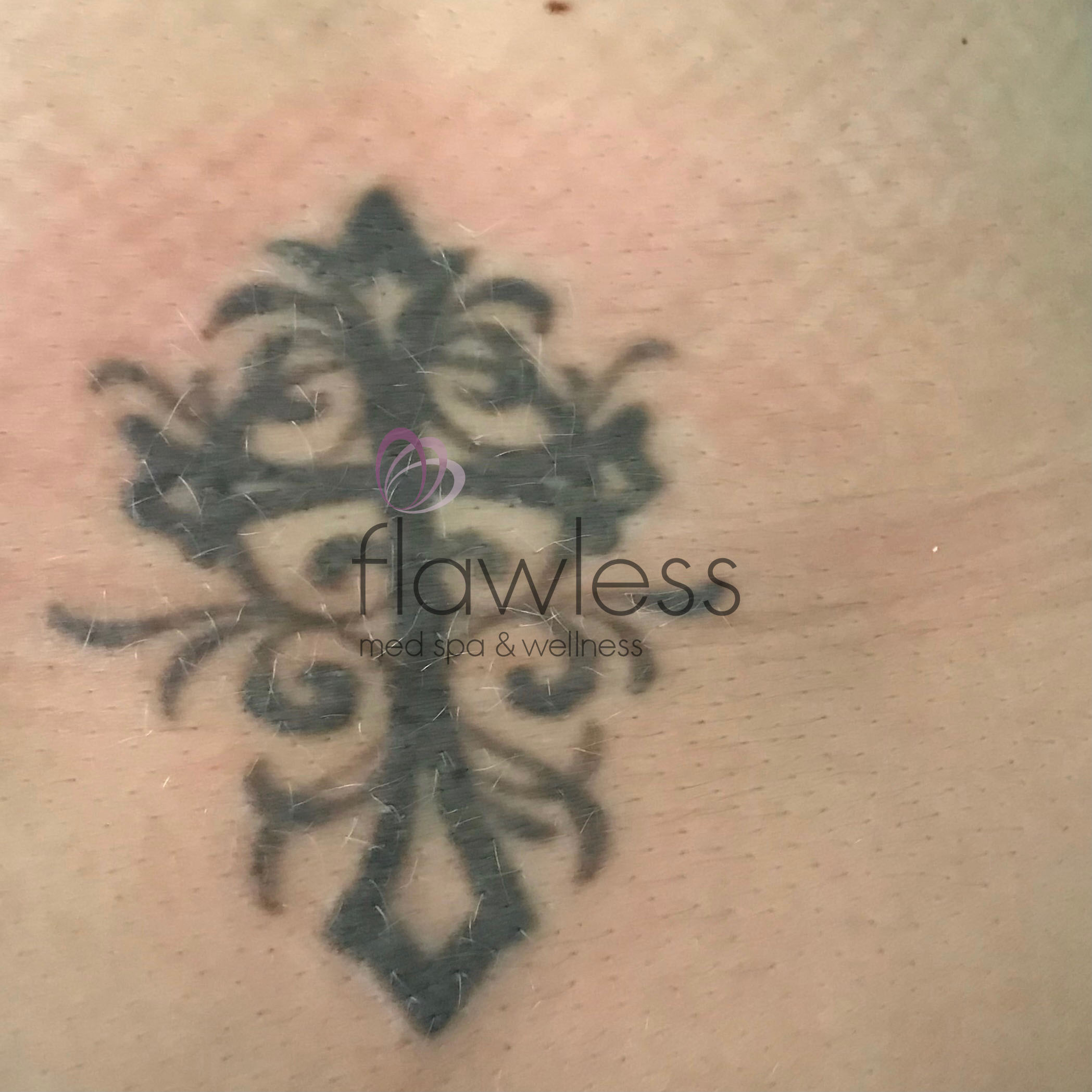Laser Tattoo Removal Before & After Gallery - Patient 58193518 - Image 1