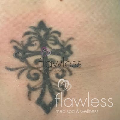 Laser Tattoo Removal Before & After Gallery - Patient 58193518 - Image 1