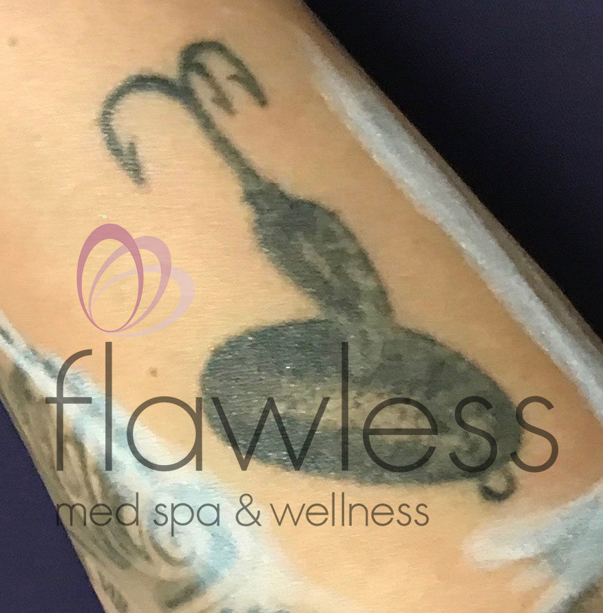 Laser Tattoo Removal Before & After Gallery - Patient 58193529 - Image 1