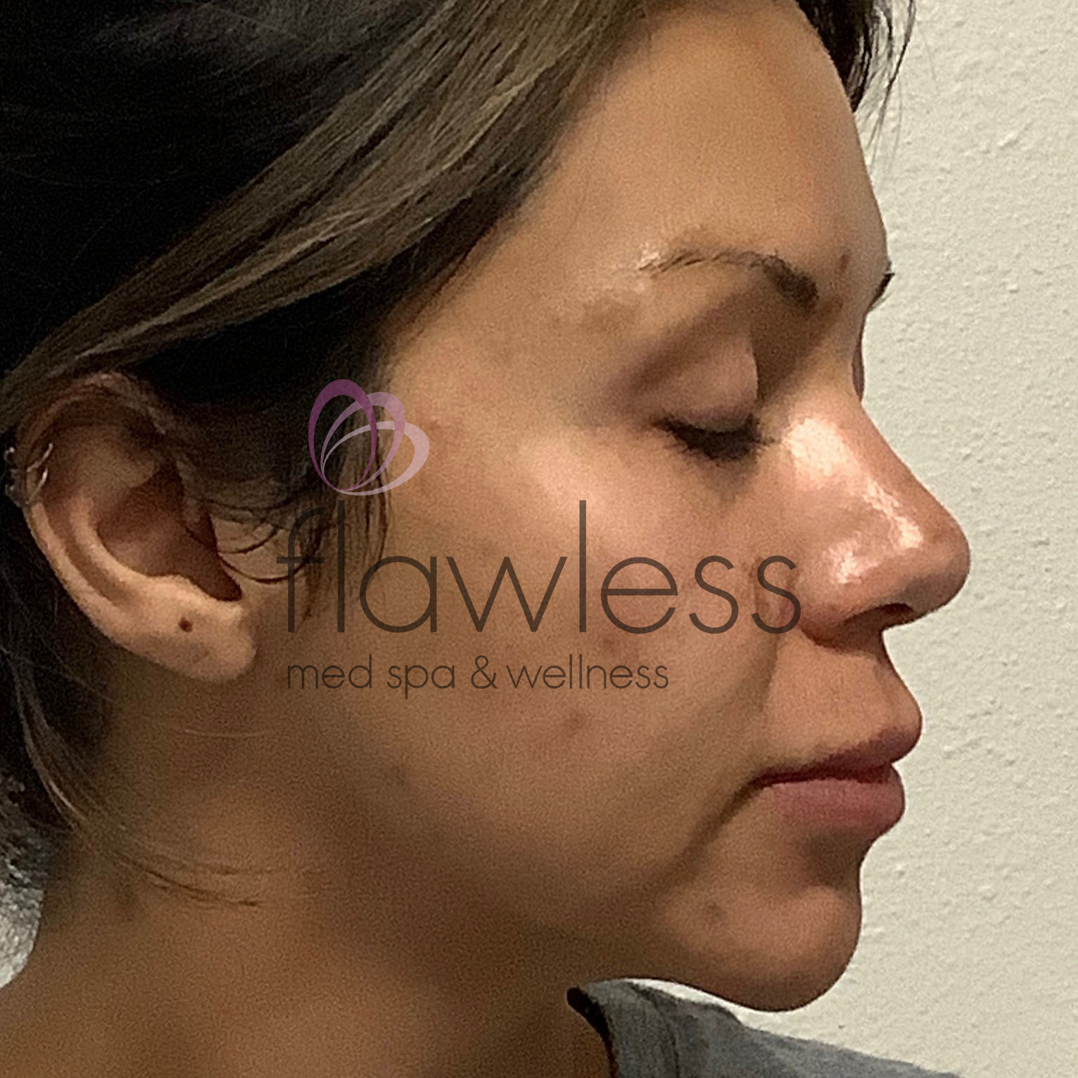 Pico Laser Skin Rejuvenation - Body Before & After Gallery - Patient 58193534 - Image 1