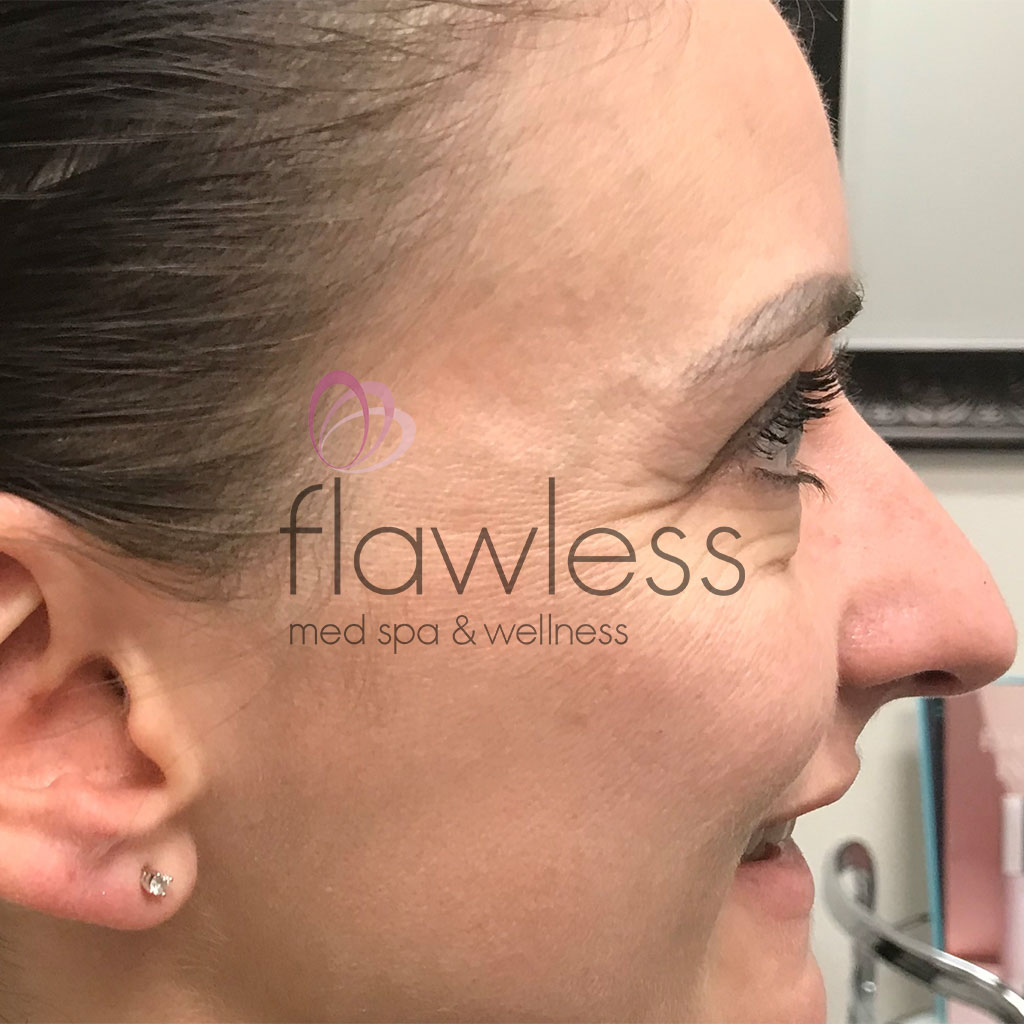 BOTOX Before & After Gallery - Patient 58193356 - Image 3