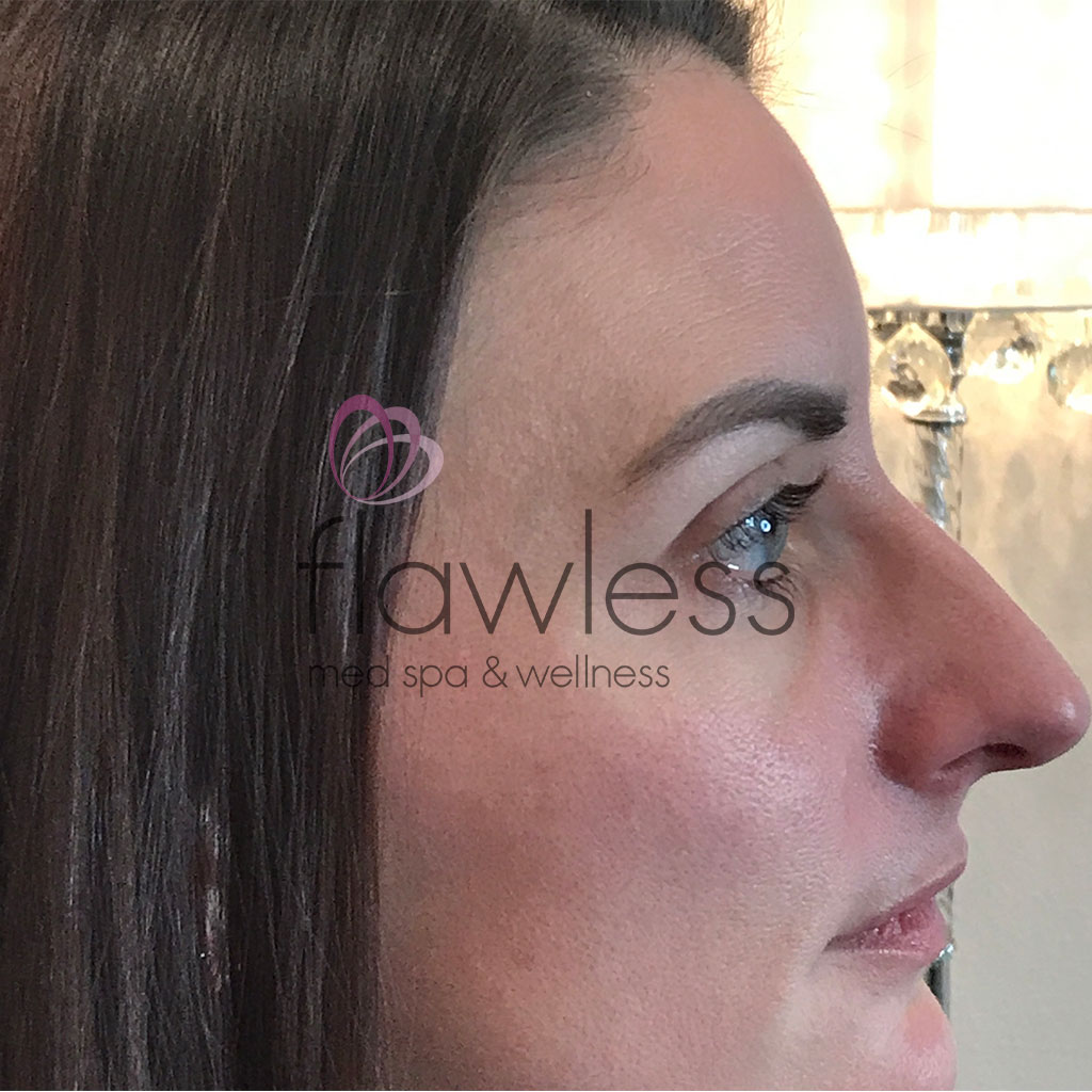 BOTOX Before & After Gallery - Patient 58193356 - Image 4