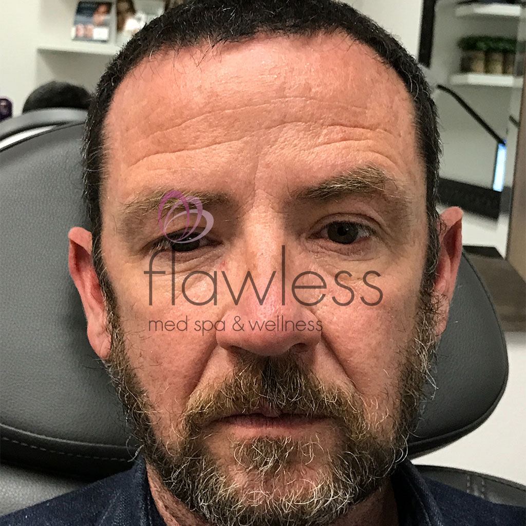 Botox for Men Before & After Gallery - Patient 58193561 - Image 2