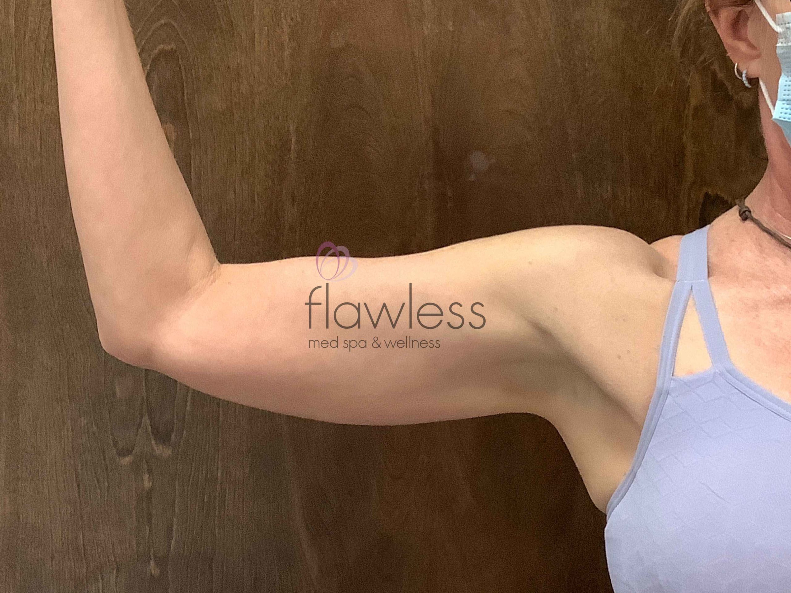 Coolsculpting Before & After Gallery - Patient 199687 - Image 1