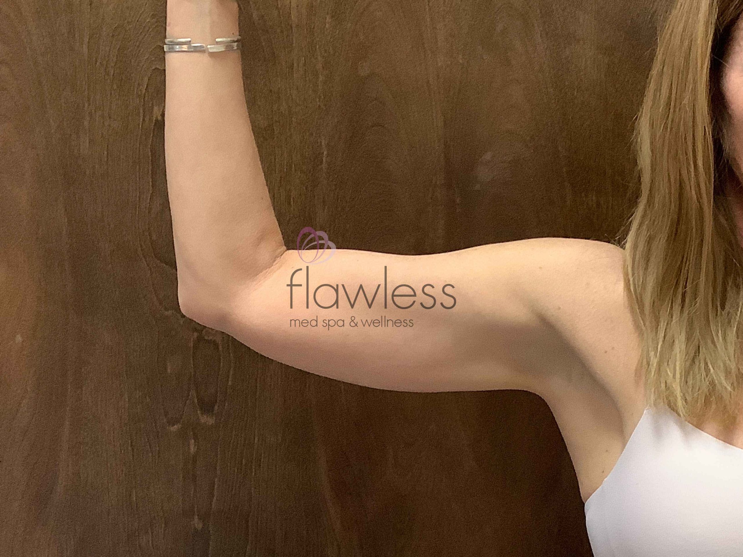 Coolsculpting Before & After Gallery - Patient 199687 - Image 2