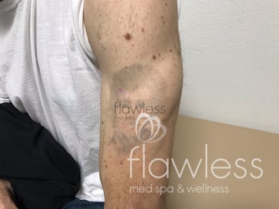 Laser Tattoo Removal - Men Before & After Gallery - Patient 58193630 - Image 2