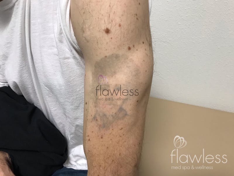 Laser Tattoo Removal - Men Before & After Gallery - Patient 58193630 - Image 2