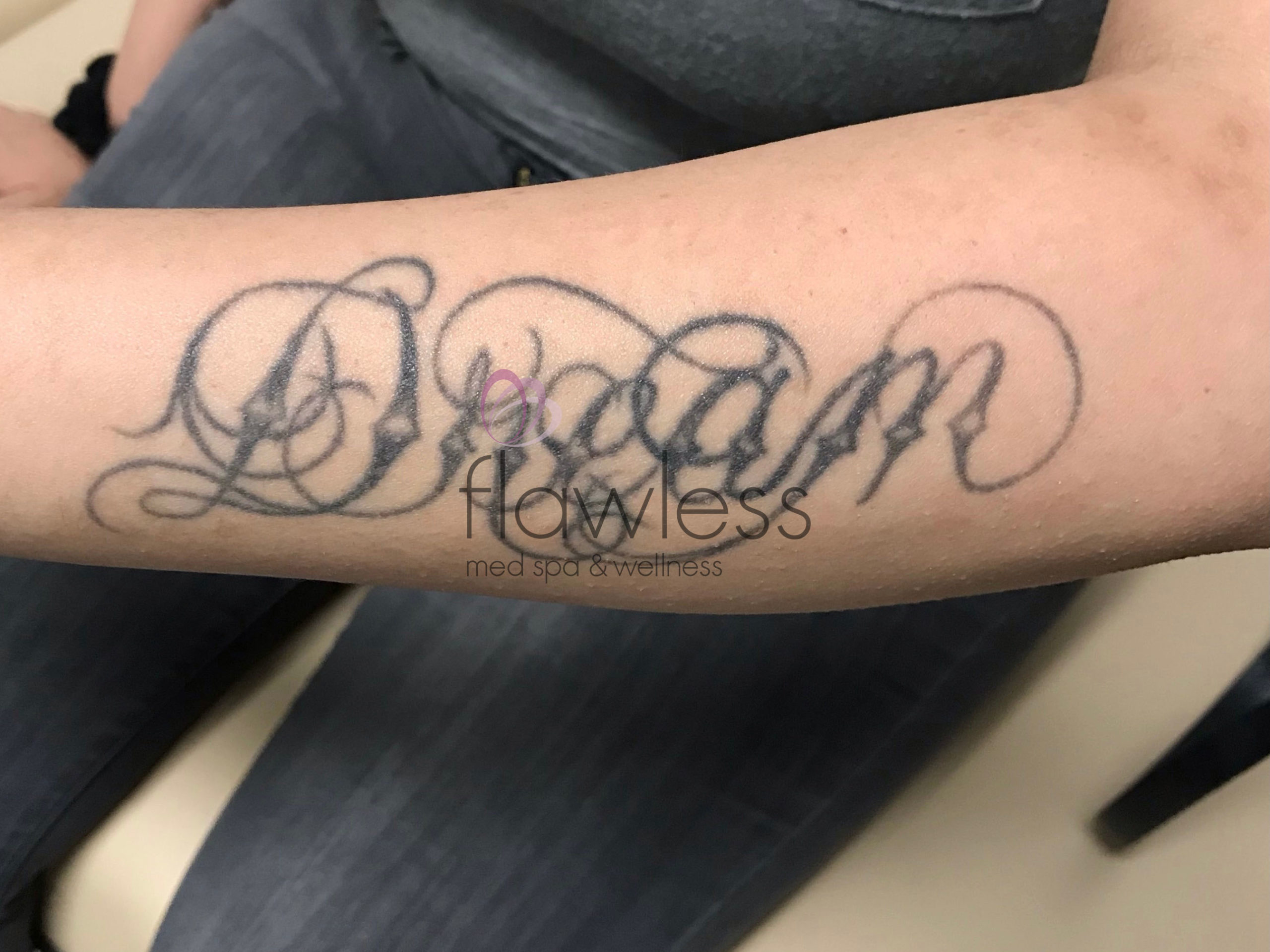 Laser Tattoo Removal - Men Before & After Gallery - Patient 58193636 - Image 1