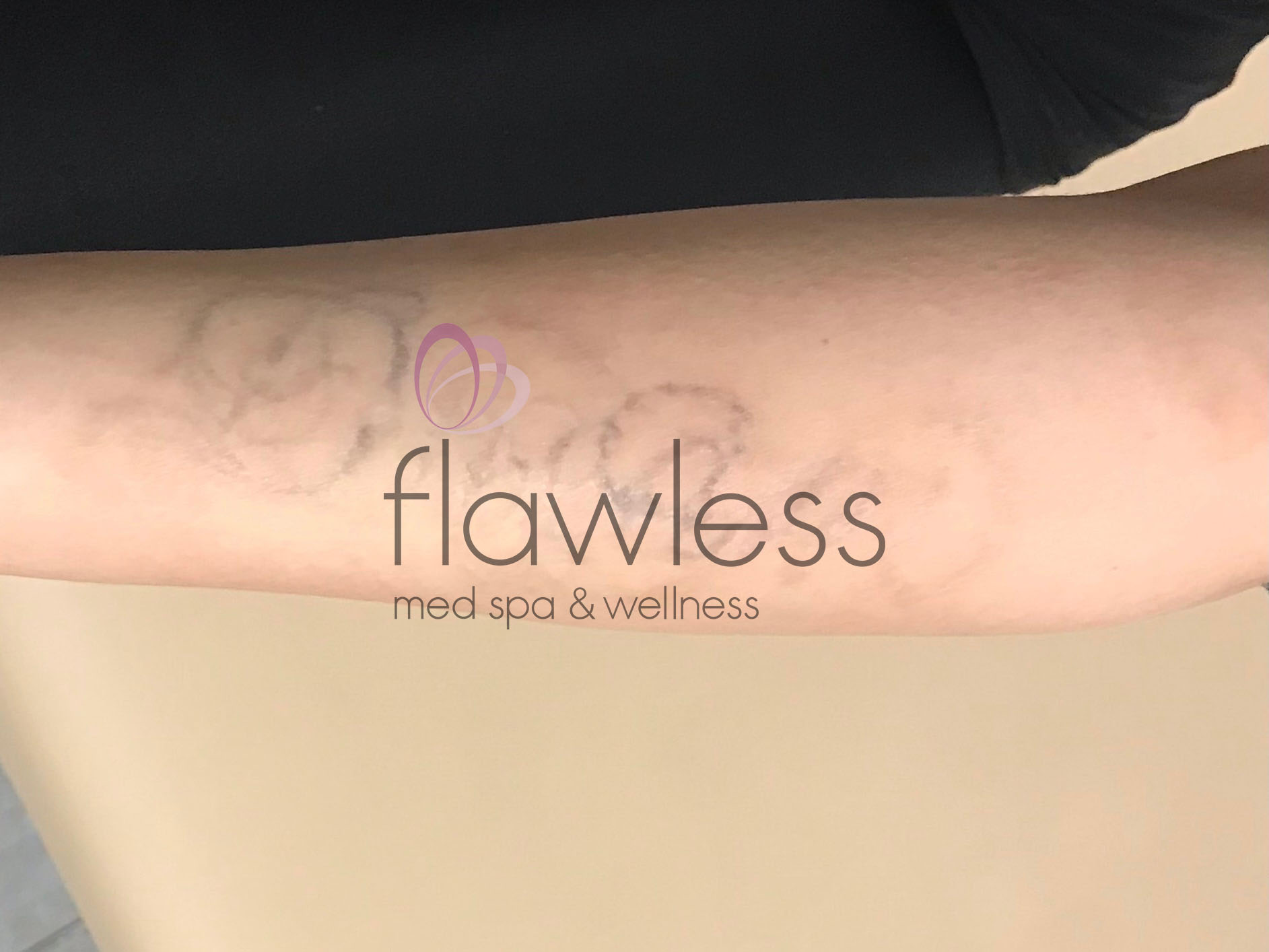 Laser Tattoo Removal - Men Before & After Gallery - Patient 58193636 - Image 2