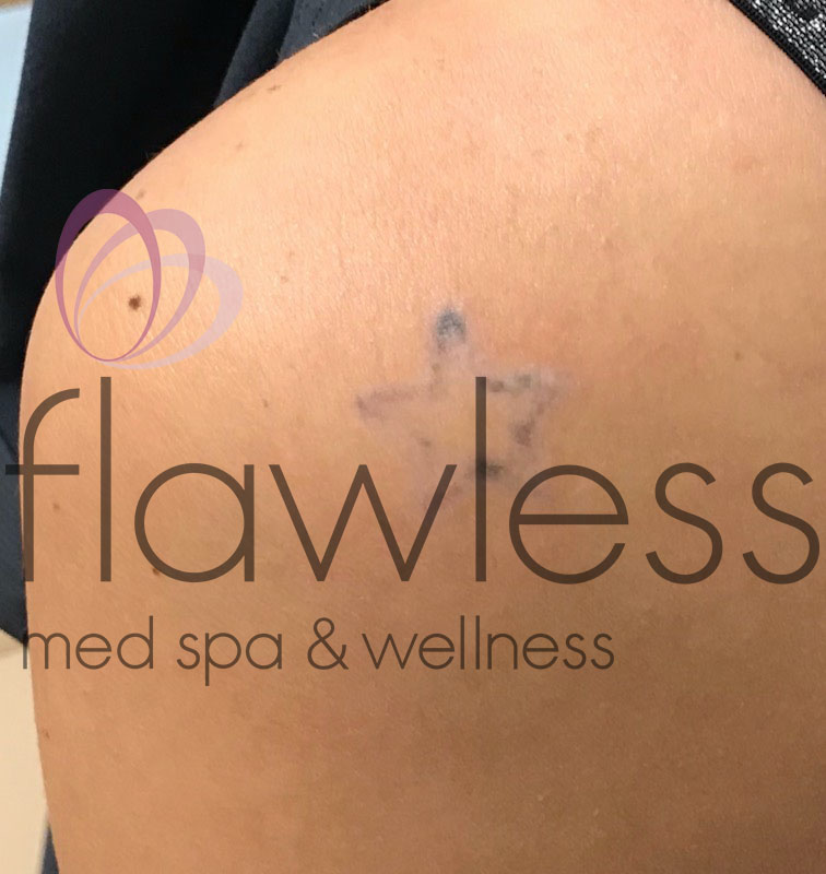 Laser Tattoo Removal - Men Before & After Gallery - Patient 58193639 - Image 2
