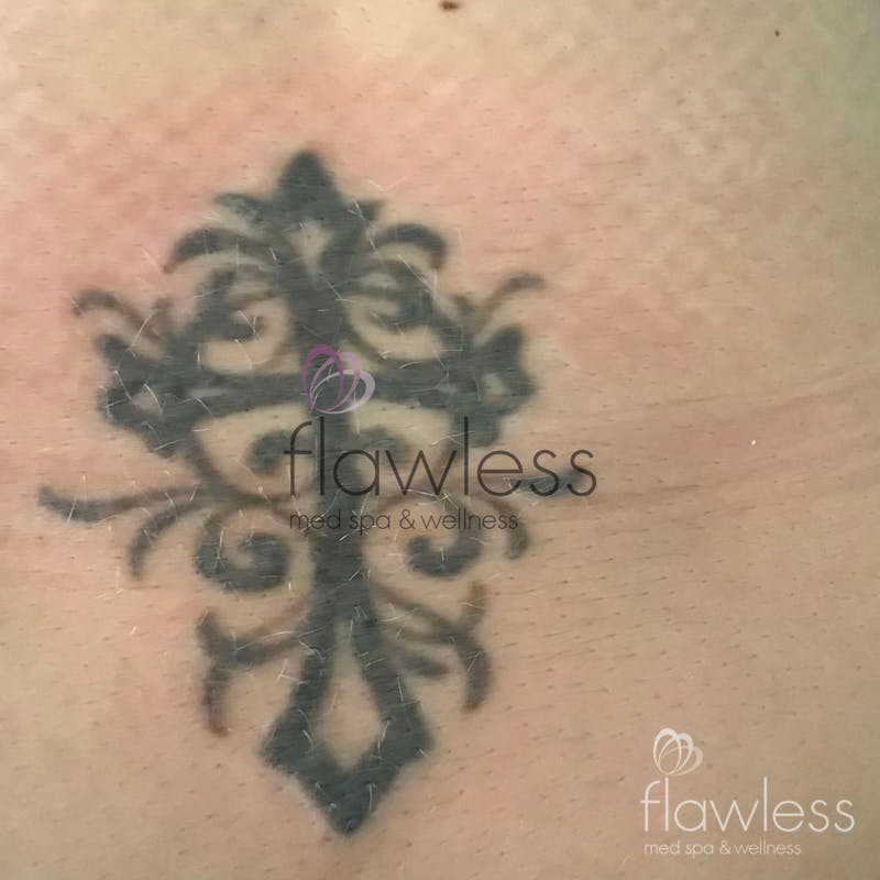 Laser Tattoo Removal - Men Before & After Gallery - Patient 58193641 - Image 1