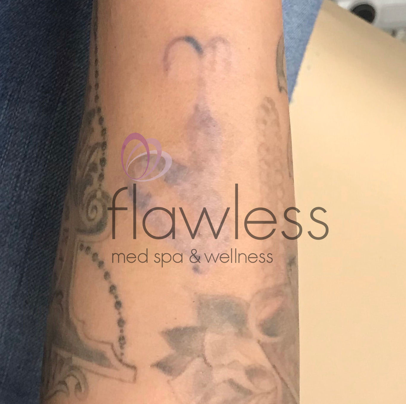 Laser Tattoo Removal - Men Before & After Gallery - Patient 58193646 - Image 2