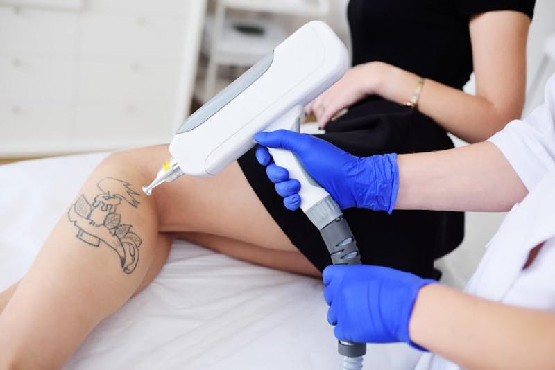 About Laser Tattoo Removal In Albuquerque, NM | Flawless Med Spa