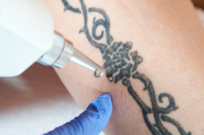 laser tattoo removal