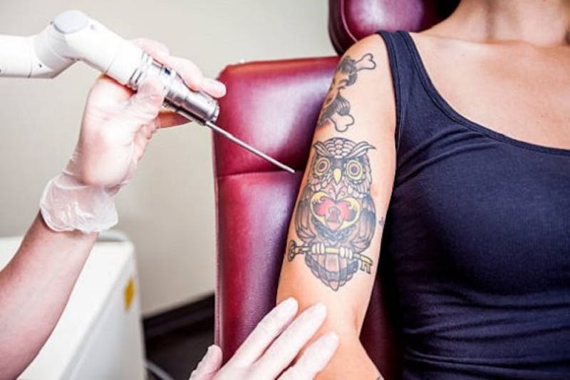 Does Laser Tattoo Removal Work On Color Tattoos:- Does Laser Tattoo Removal Work On Color Tattoos:-