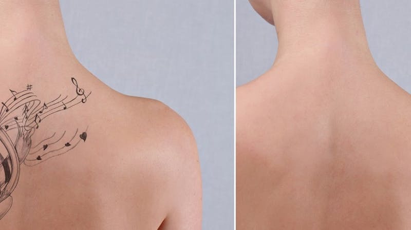 before and after tattoo removal