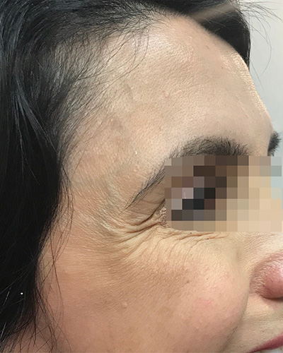 BOTOX Before & After Gallery - Patient 58202278 - Image 1