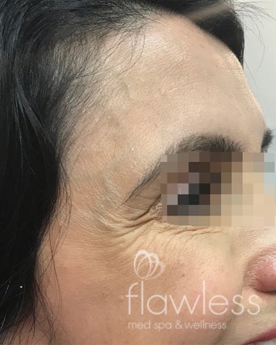 BOTOX Before & After Gallery - Patient 58202278 - Image 1