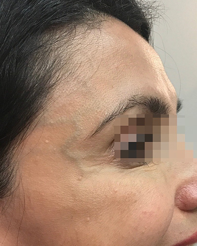 BOTOX Before & After Gallery - Patient 58202278 - Image 2